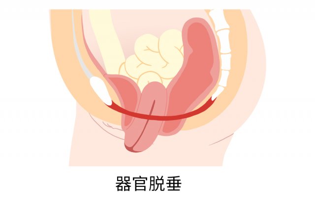 60-70%的产后盆腔脱垂症状可以通过这个方法缓解