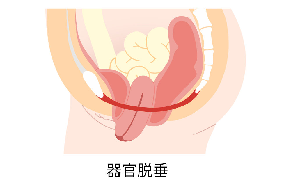 60-70%的产后盆腔脱垂症状可以通过这个方法缓解(图1)
